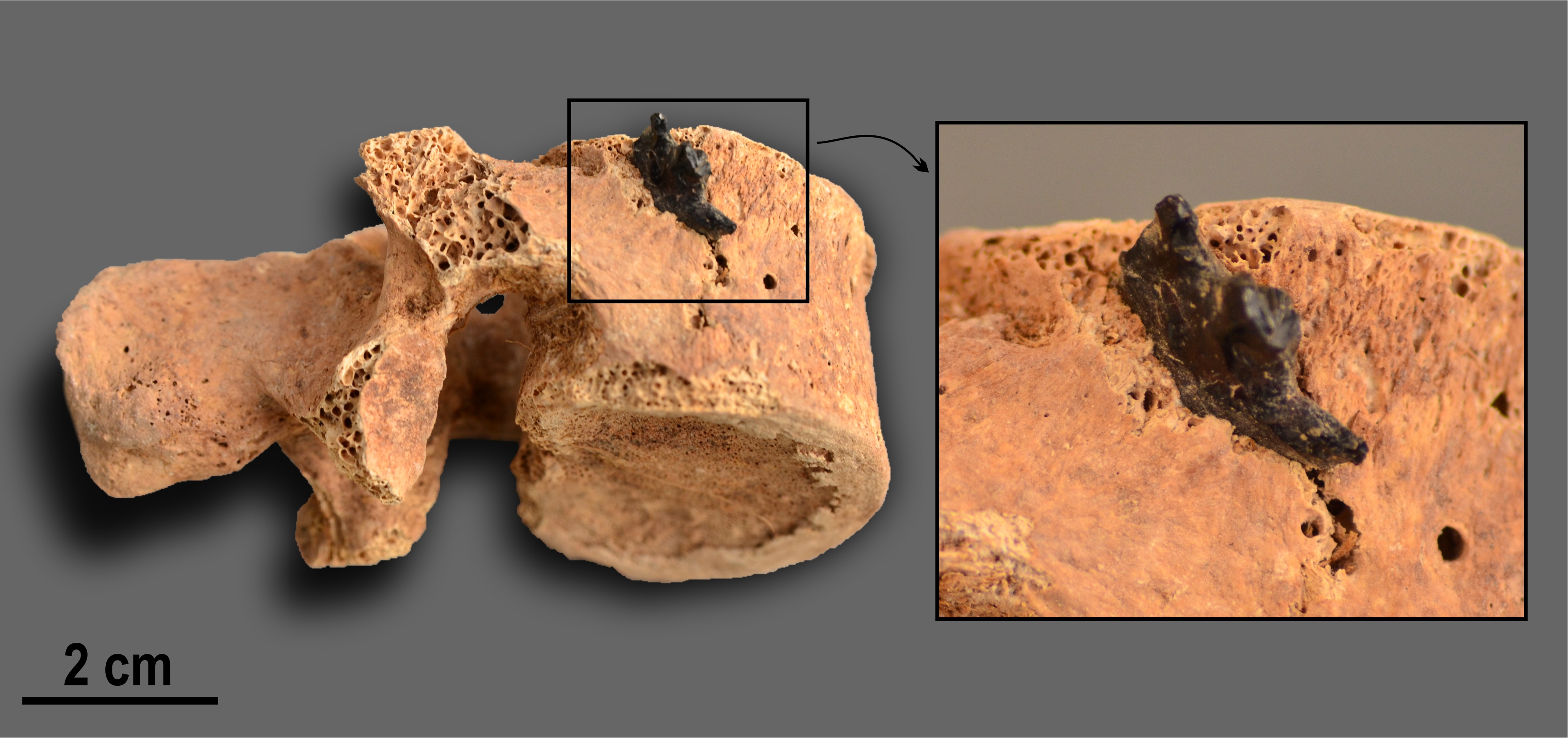 Una vértebra humana con punta de proyectil incrustada